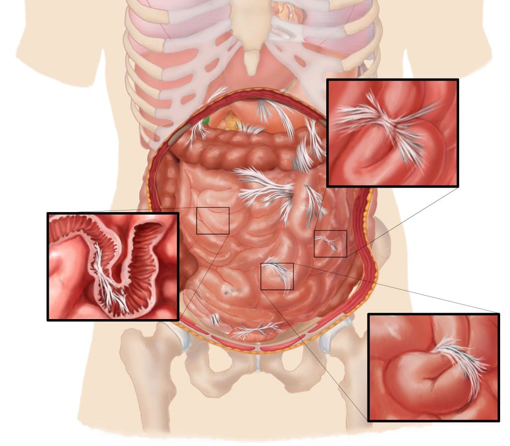 What is Abdominal Adhesiolysis?