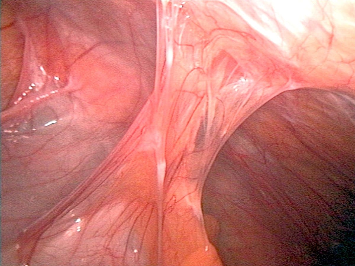 Abdominal Adhesiolysis