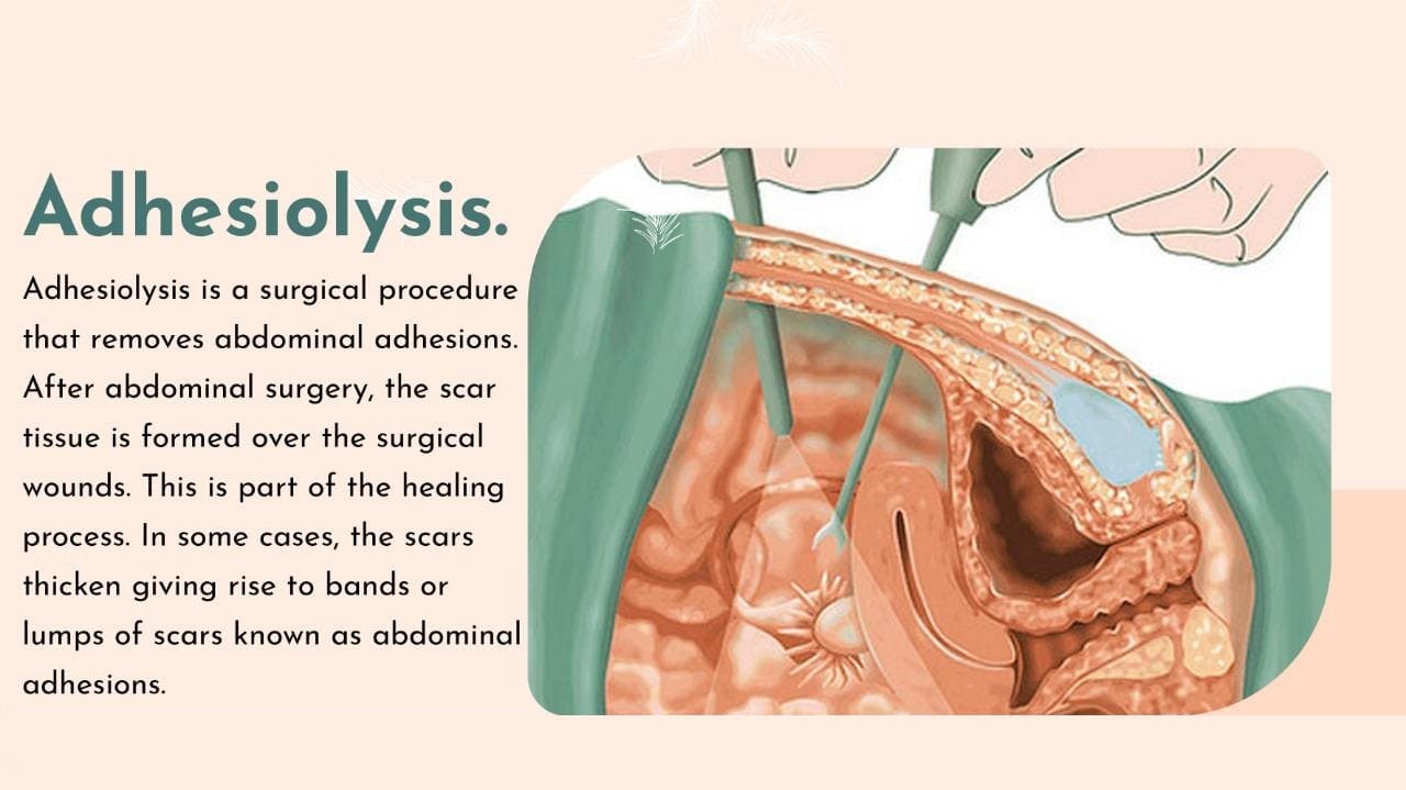 Adhesiolysis
