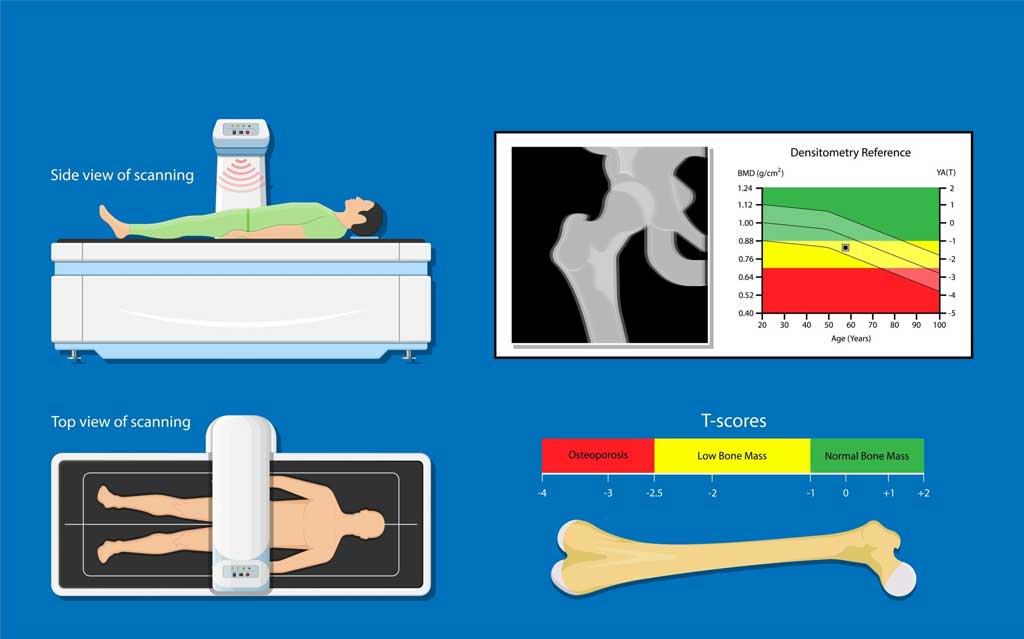 Bone Density Scan