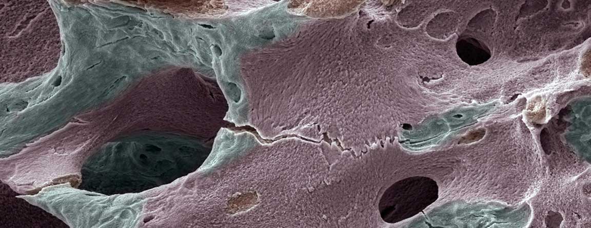 Bone Densitometry