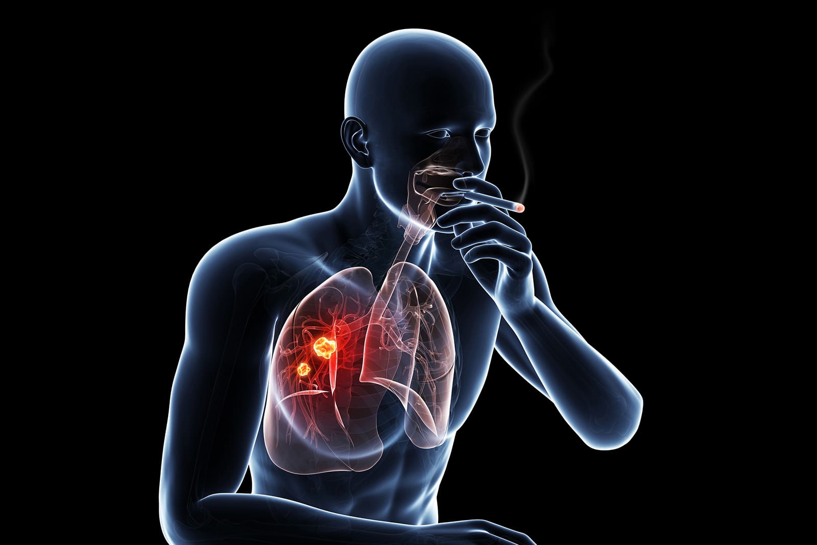 Lung Cancer