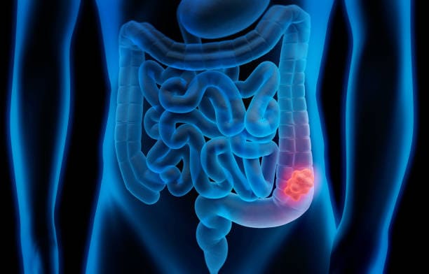 what is a colonoscopy