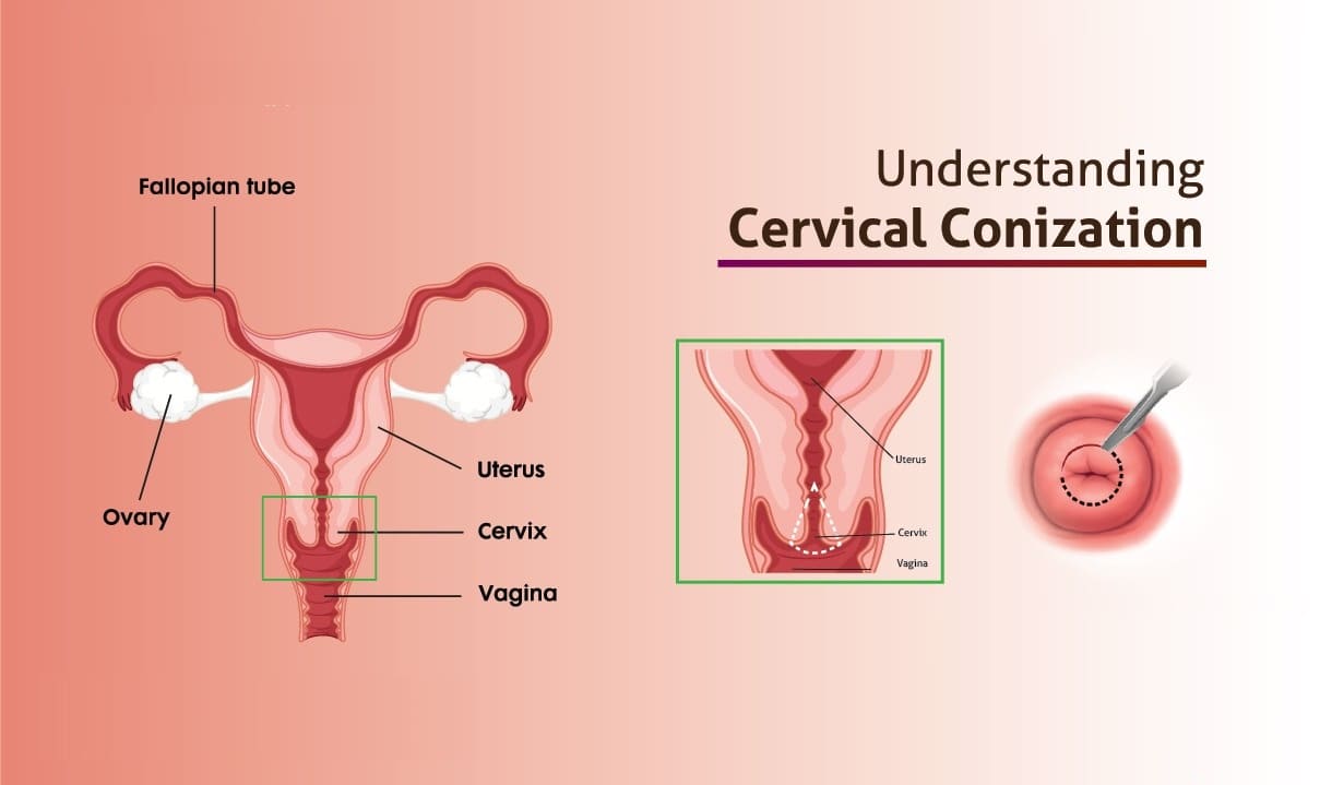 What is a Cone Biopsy?