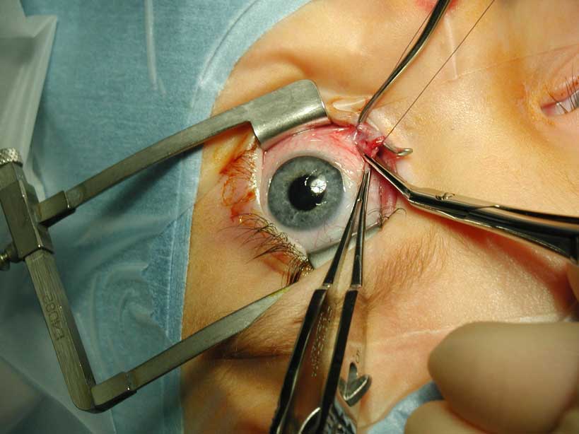 What is Eye Muscle Repair Surgery? | Hill Regional Hospital