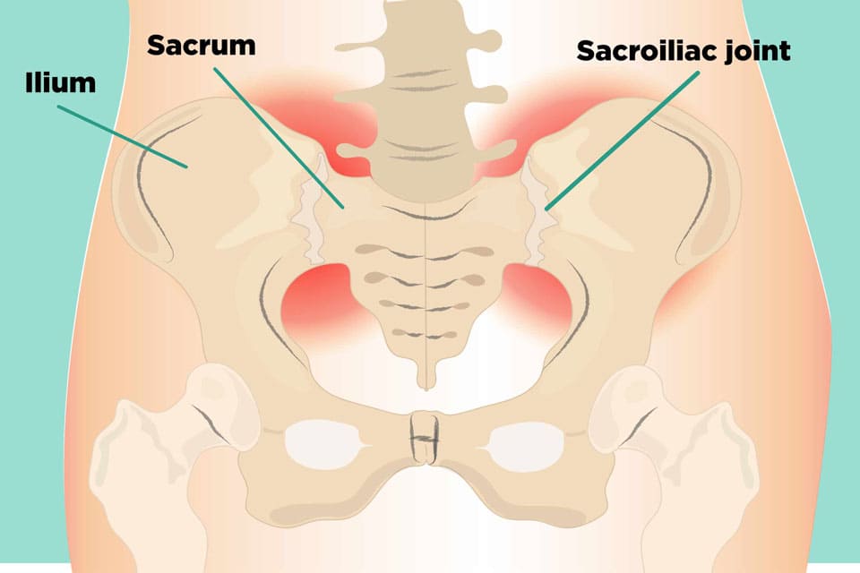 Symptoms of SI joint pain