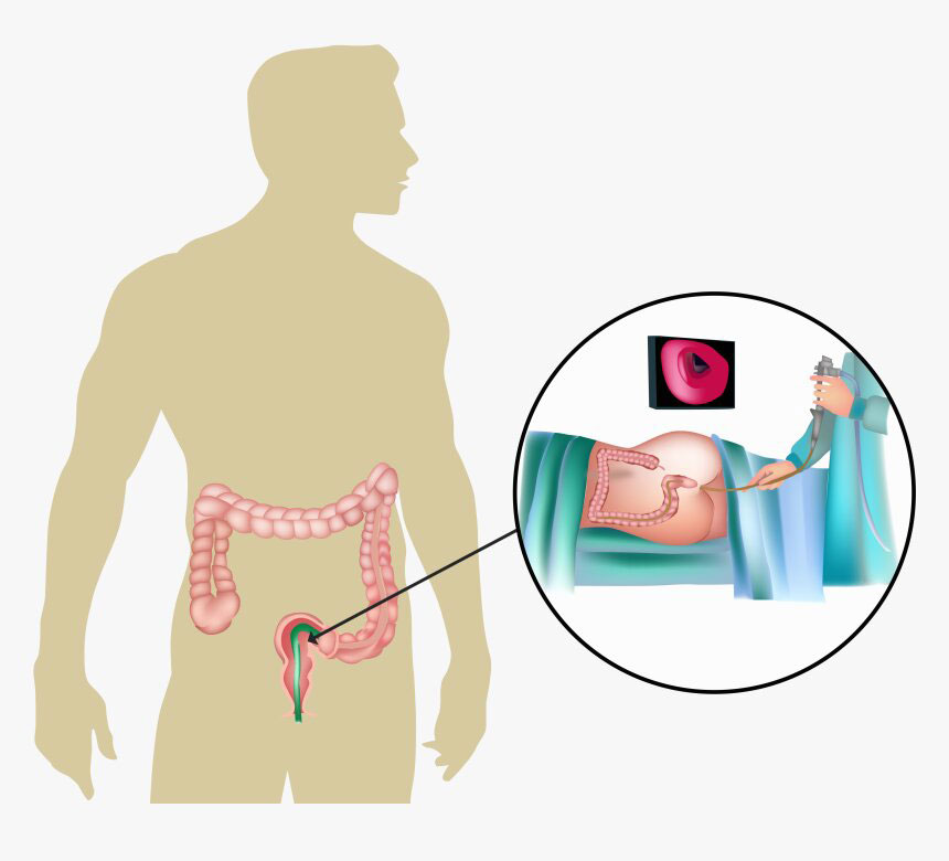 Flexible Sigmoidoscopy Preparation