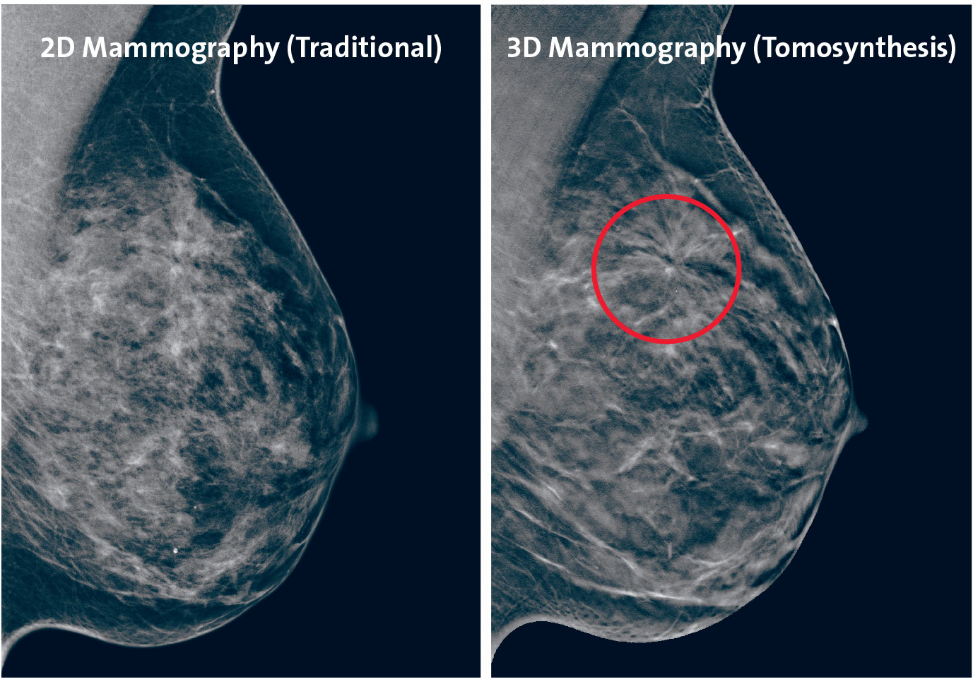 Breast Tomosynthesis