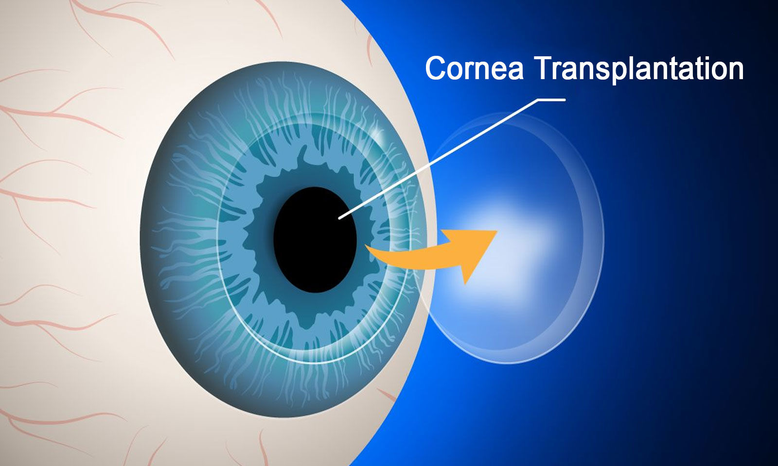 Cornea Transplant