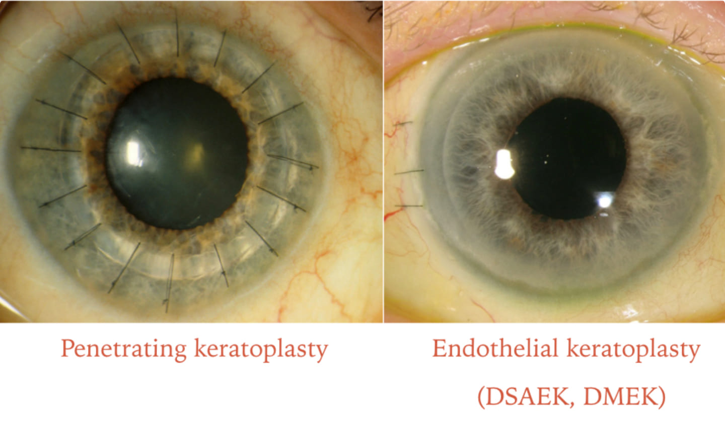 Keratoplasty