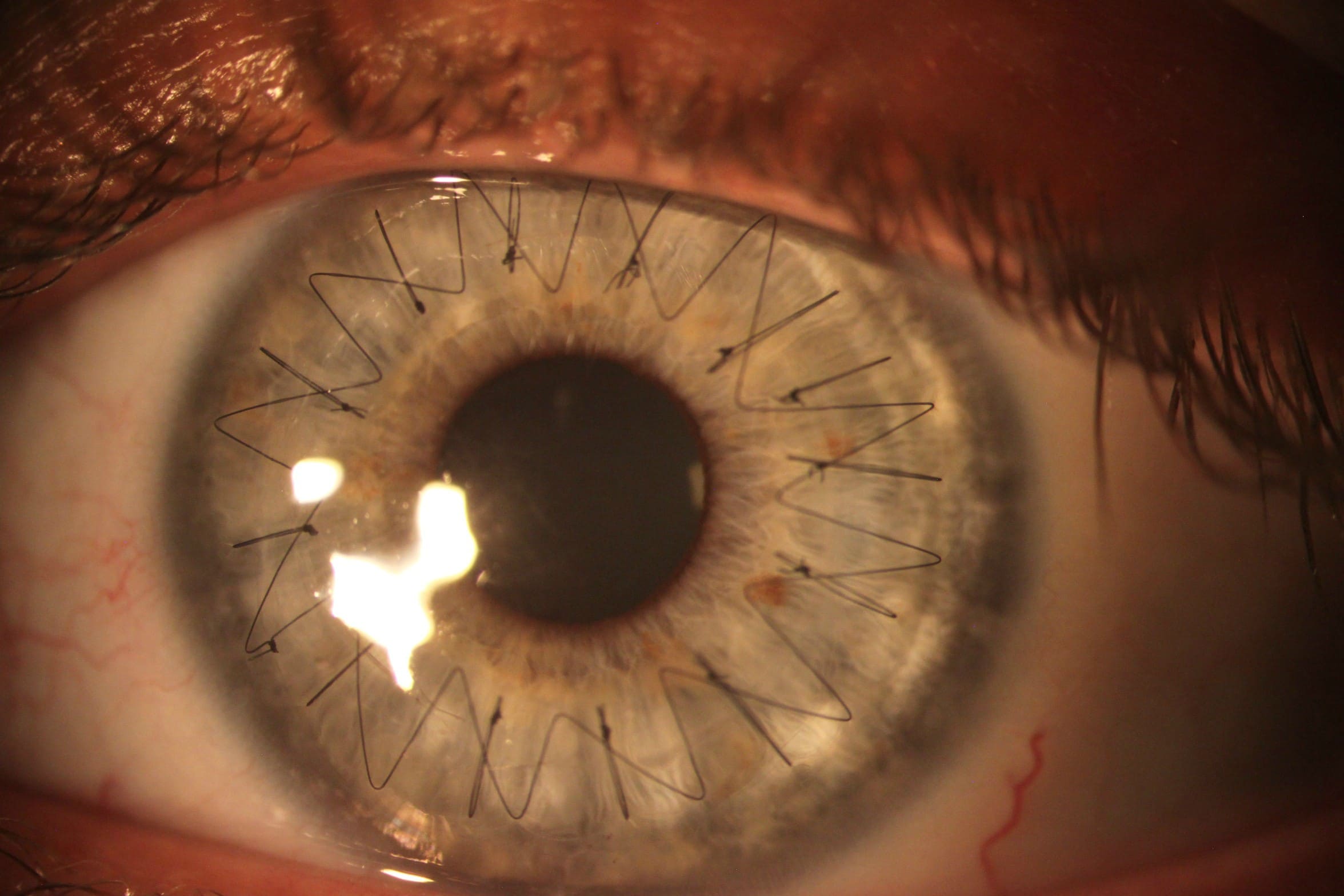 Cornea Transplant Procedure