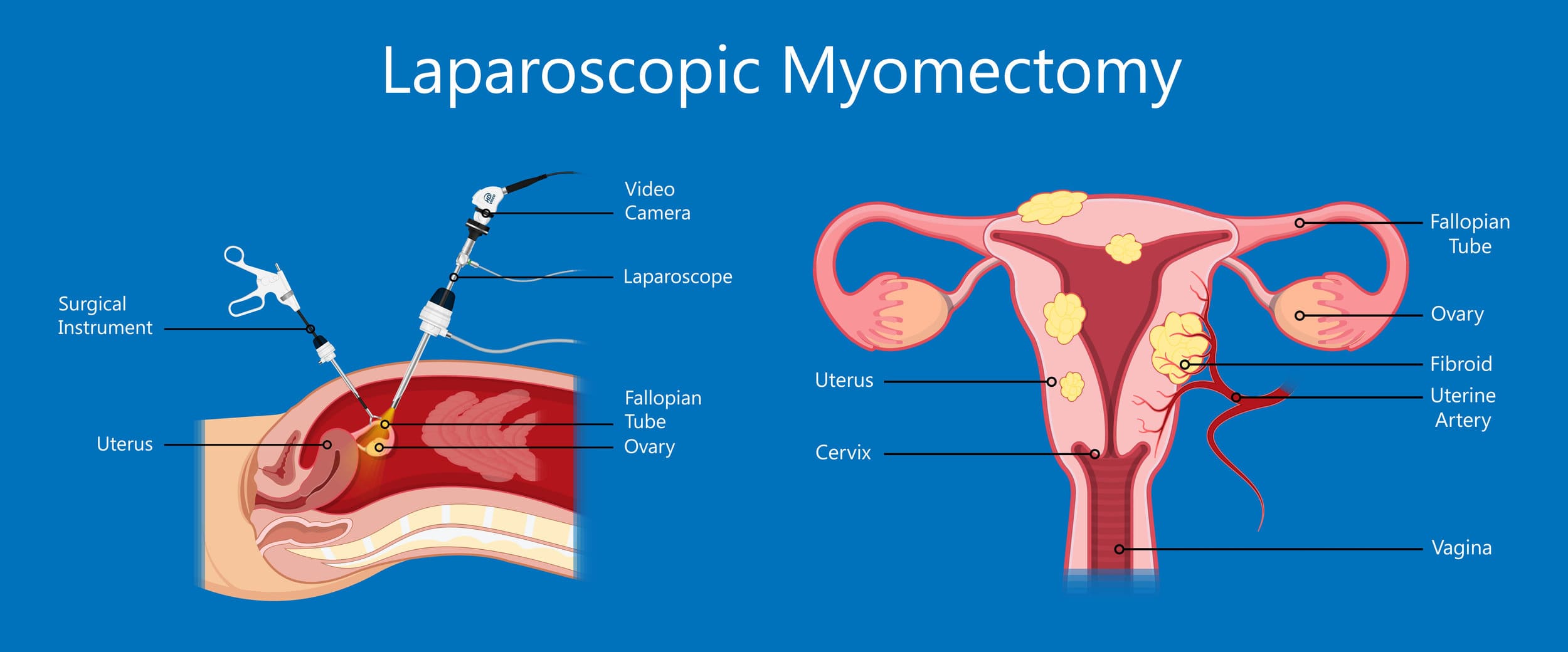 What is Myomectomy?