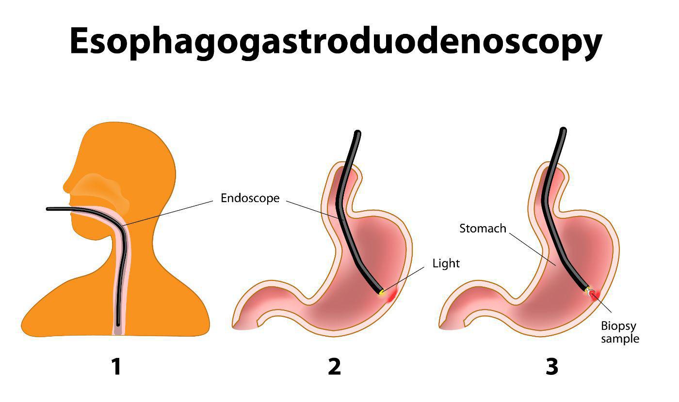 Esophagogastroduodenoscopy (EGD)