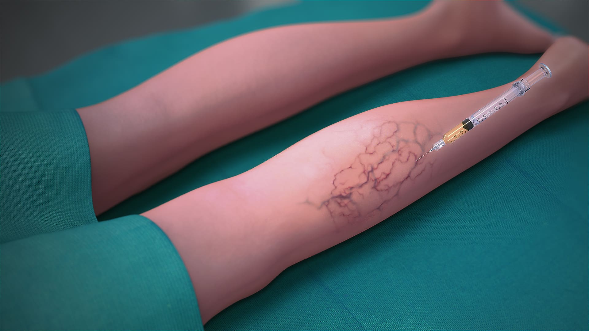 What is Sclerotherapy?