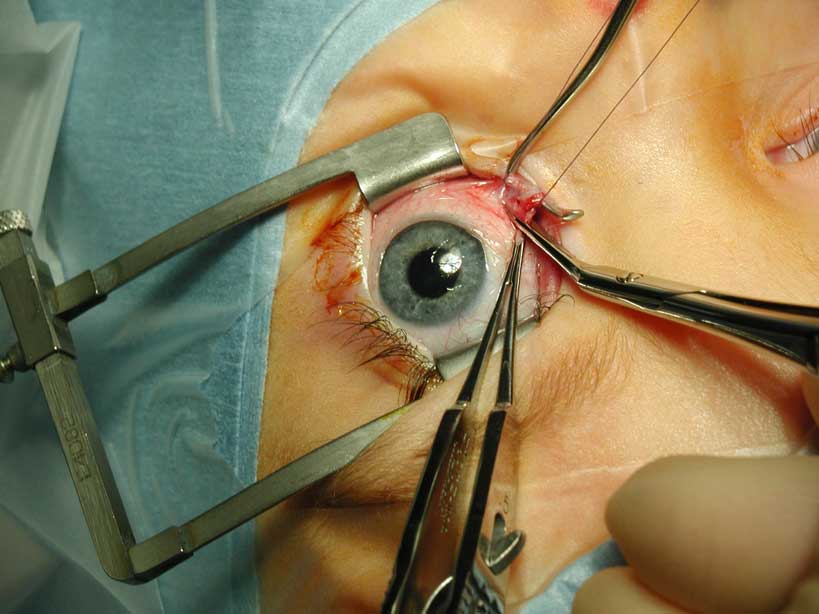What is Eye Muscle Repair Surgery?