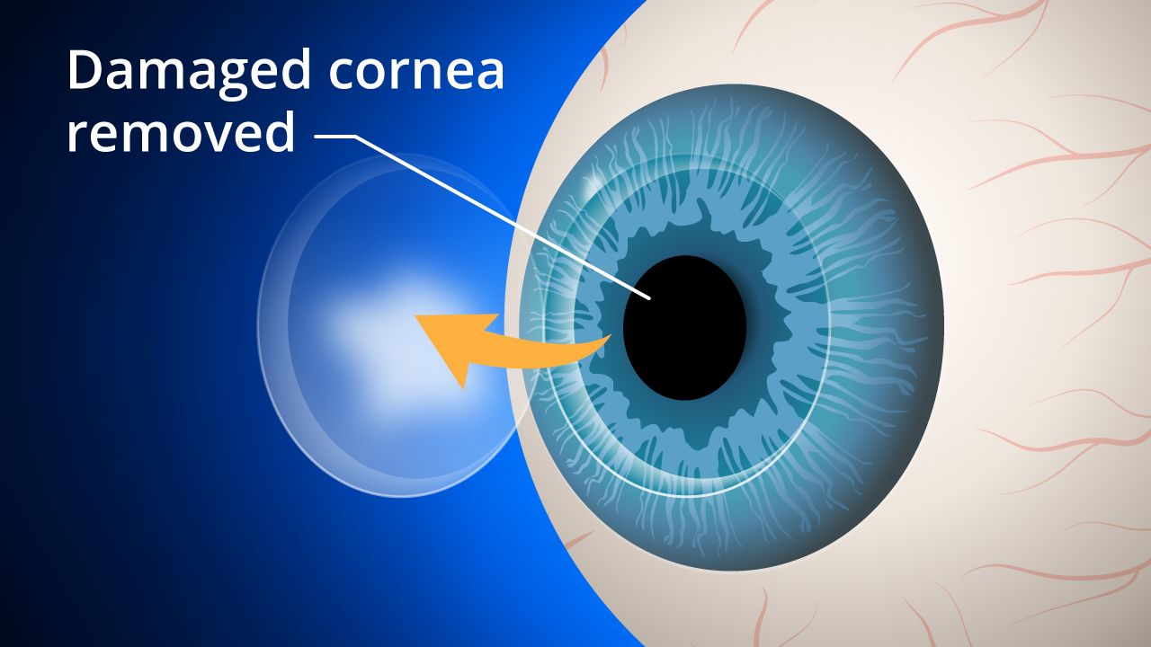 What is Cornea Transplant?